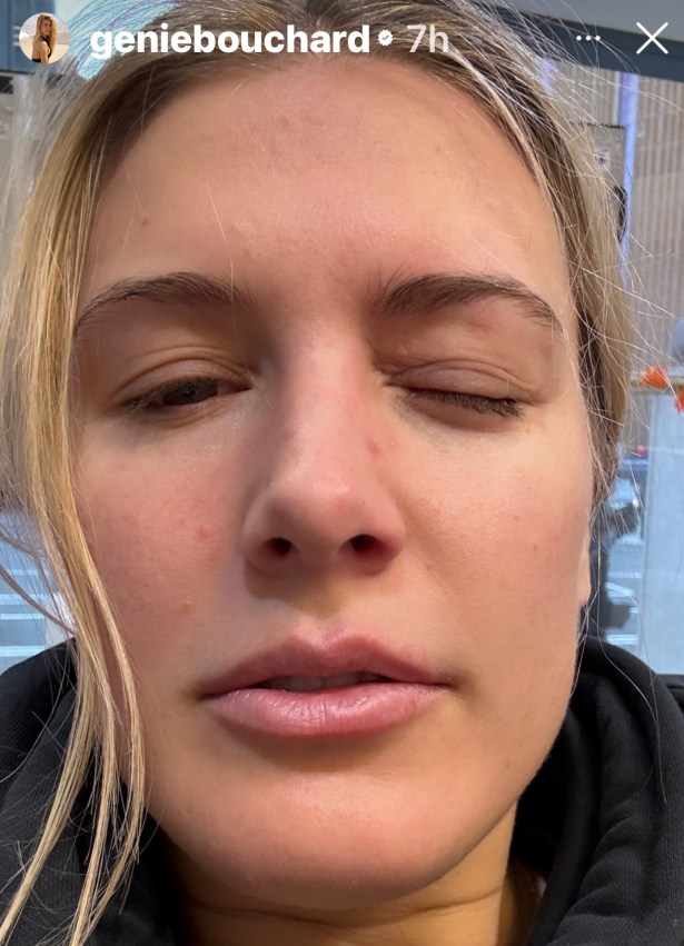 Tennis Star Genie Bouchard suffers An Eye Injury Playing Pickleball